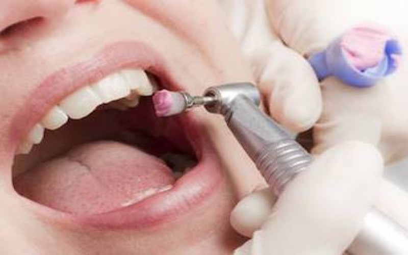 Teeth cleaning and lime removal + treatment plan for 129 riyals